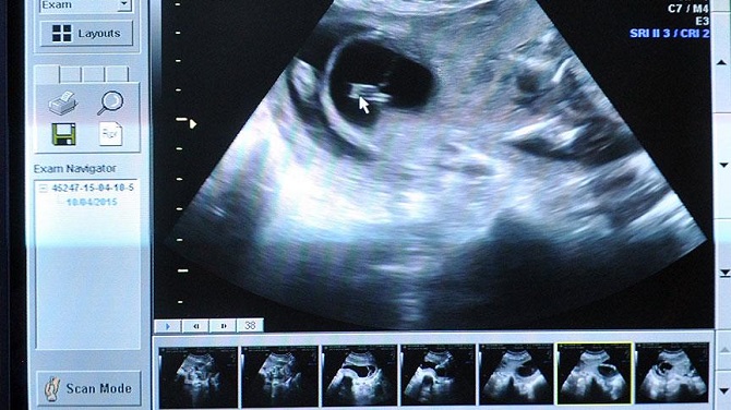 Gebelik zehirlenmesine detaylı ultrason ile erken teşhis