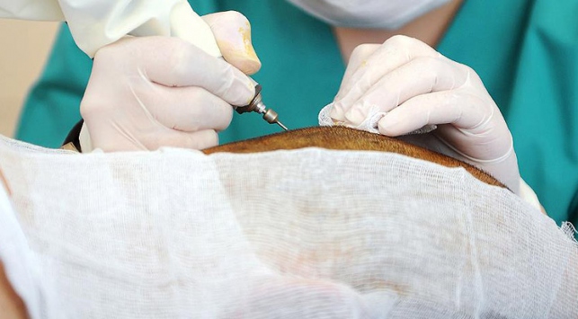 Saç ekiminde dünya birincisi olduk