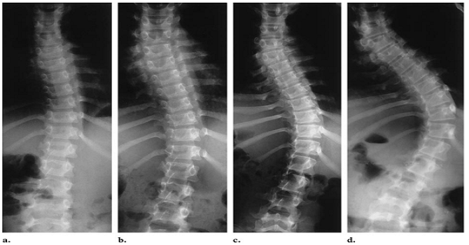 Omurga eğriliği tedavisinde erken teşhis önemli