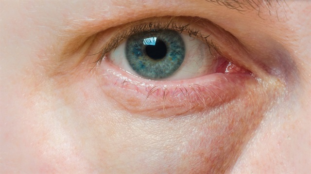 Göz altı torbaları görüntüyü bozuyor