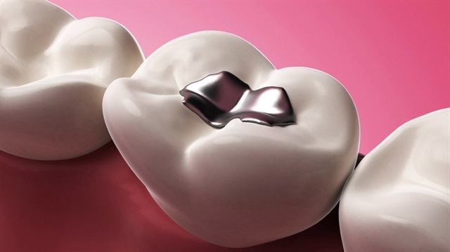 Dişlerinize cıvalı dolgu yaptırmayın