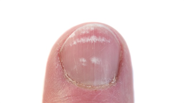 Tırnak batmasına 'tel'li çözüm