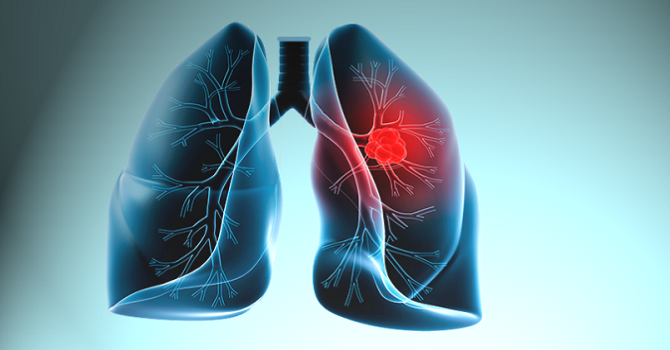 Ülkemizde her yıl 18 bin kişiye akciğer kanseri teşhisi konuluyor
