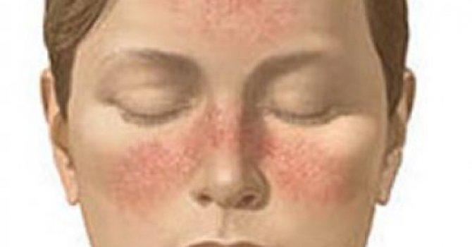 Bahar aylarında gül hastalığına dikkat!