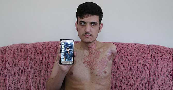 Savaşta hem gözlerini hem ailesini kaybetti