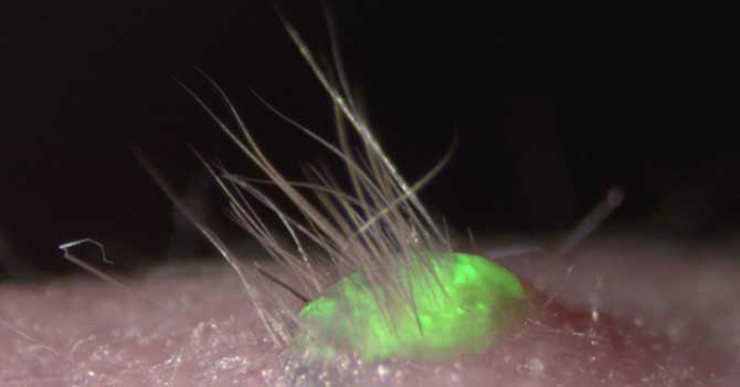 Kellik tedavisinde yeni çare göründü