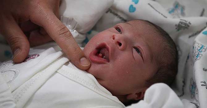 İki dişli doğan bebek şaşırttı