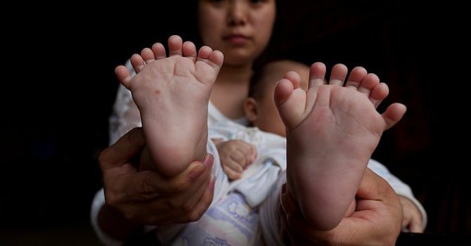 Çin'de Bir Bebek Toplam 31 El ve Ayak Parmağıyla Doğdu