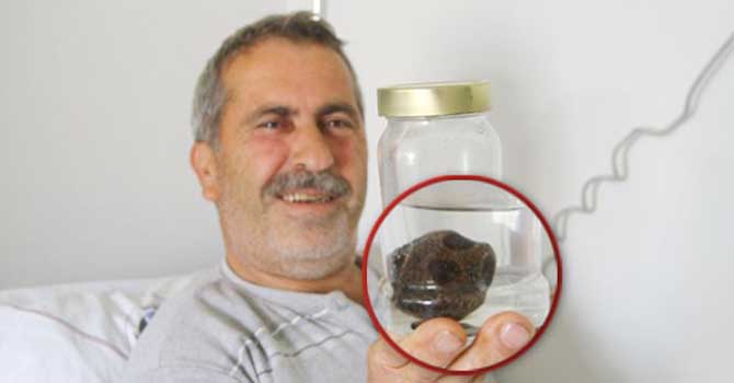 Hastanın böbreğinden çıkan taş doktorları bile şaşırttı