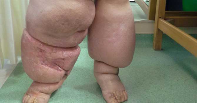 Fil hastalığıyla 40 yıl mücadele etmişti