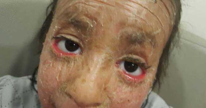 'Balık pulu' hastalığına çareyi termal suda arıyor