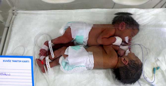 Yapışık ikizler dünyaya geldi