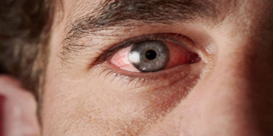 Göz altı torbalarına dikkat