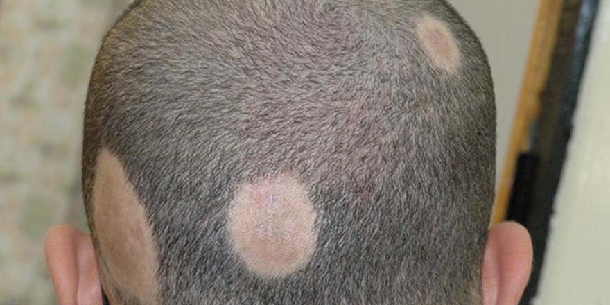 Okul stresi saçkırana yol açabilir