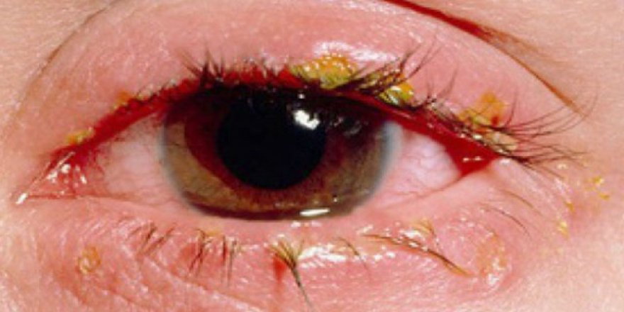 Göz kapağı düşüklüğüne dikkat