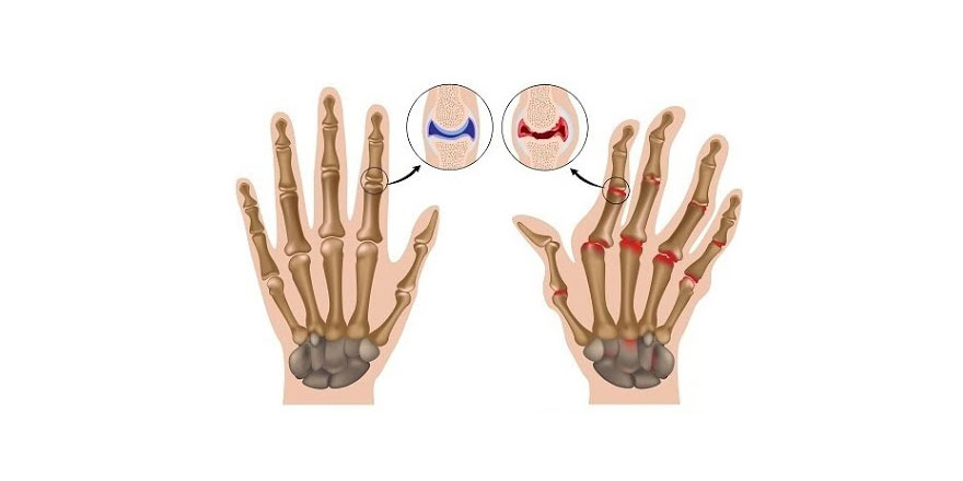 Romatoid artrit hastaların yaşamını zorlaştırabiliyor