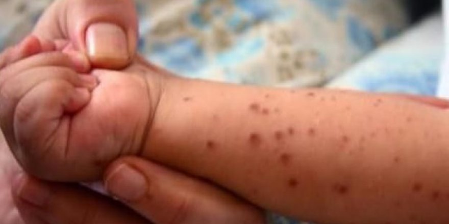 Çocuklarda el-ayak-ağız hastalığına dikkat!