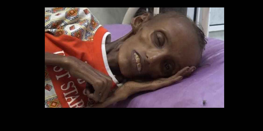İran ve Arabistan kavga ederken Yemenliler açlıktan ölüyor