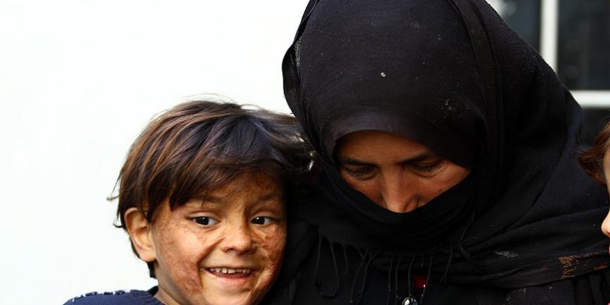 Minik Suriyeli savaşın izlerini yüzünde taşıyor