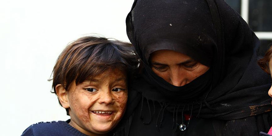 Minik Suriyeli savaşın izlerini yüzünde taşıyor