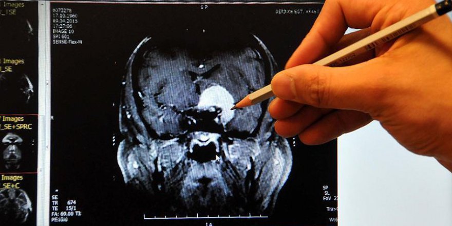 Beynin şekli kişilik farklarını belirliyor