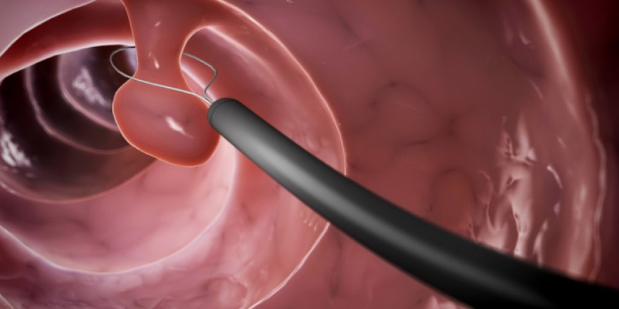 Kolon kanserinde 'polip' uyarısı