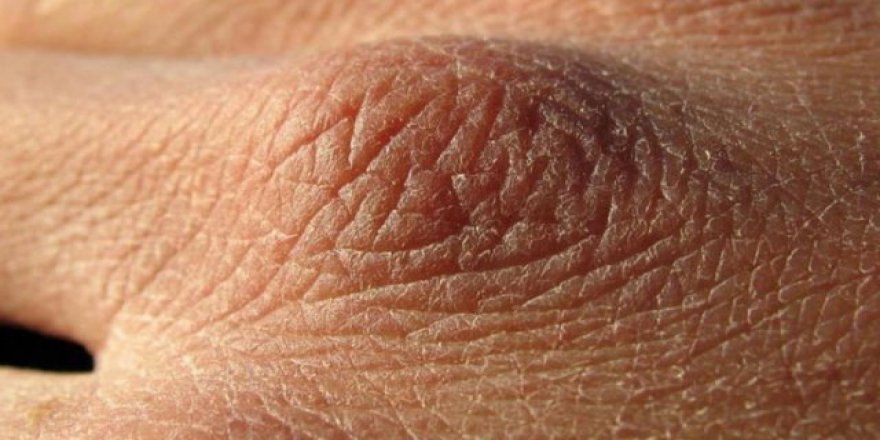 Yeterli su içmediğinizin işaretleri