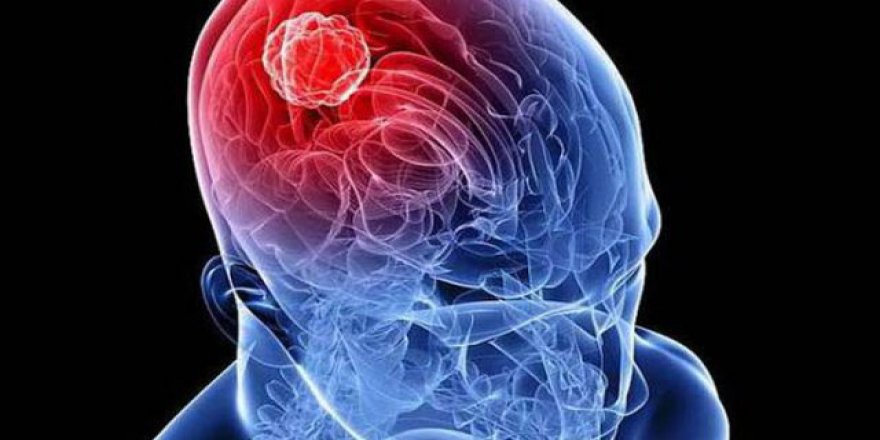 Beyin tümörü belirtileri ve kaynağına dikkat!