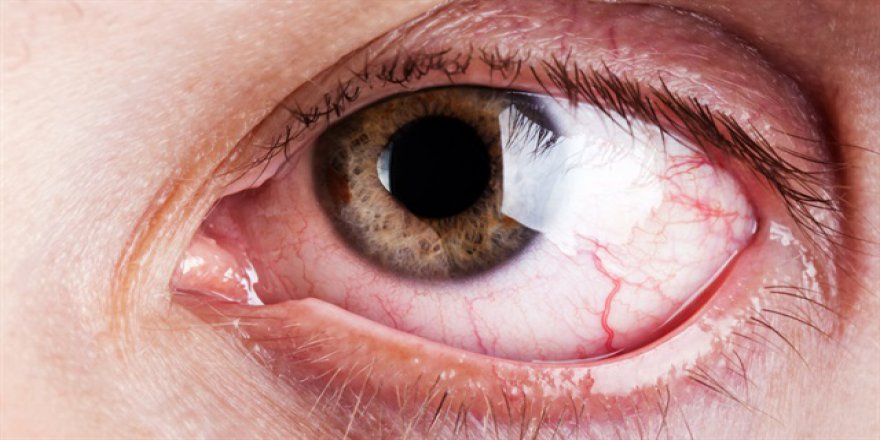 Yaz ayında göz enfeksiyonuna dikkat