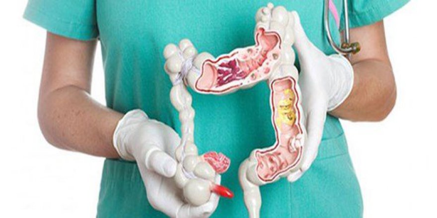 Bağırsak kanserine herkes yakalanabilir