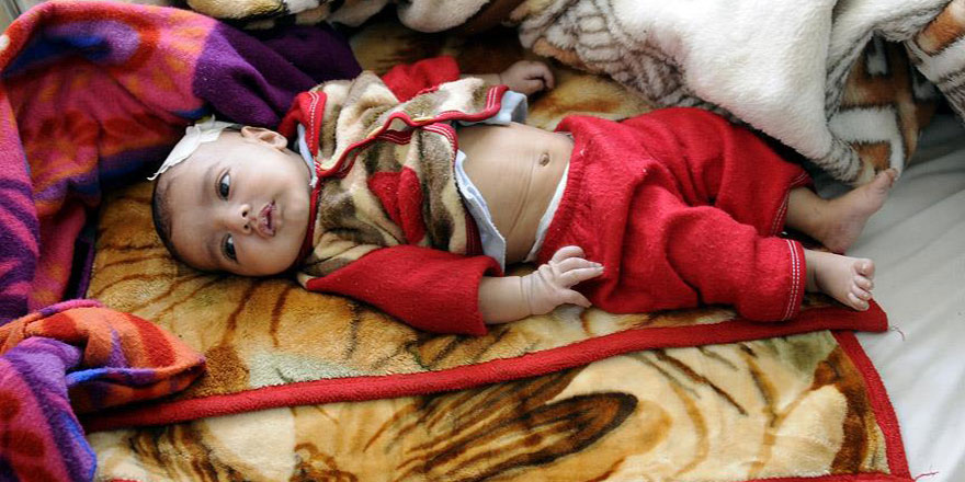 'Dünyanın en büyük insani krizi Yemen'de'