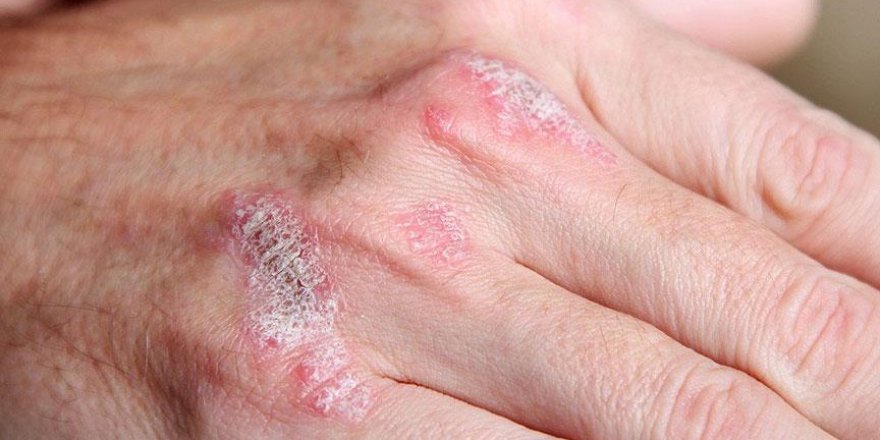 'Obezite ve sigara sedef hastalığını tetikliyor'