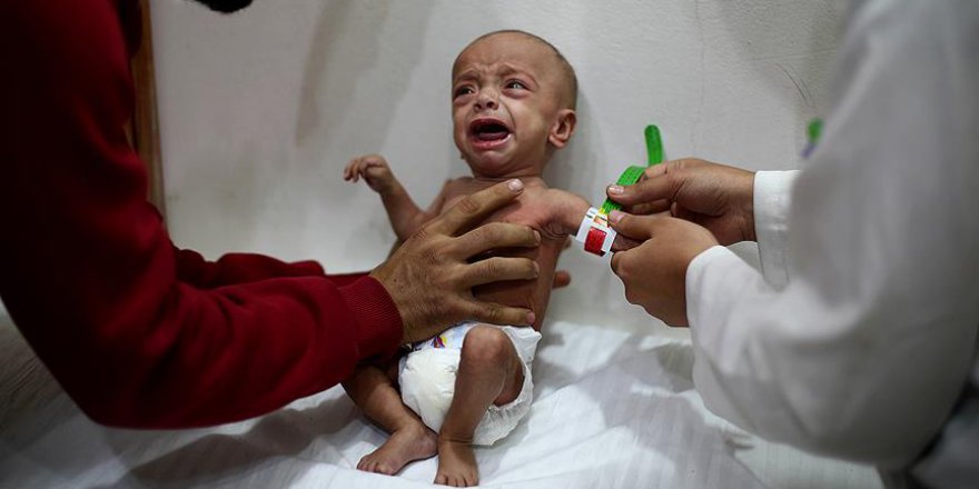 'Doğu Guta'da yetersiz beslenen çocukların sayısı ürkütücü boyutlarda'