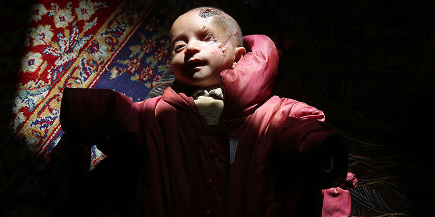 Doğu Gutalı Kerim bebek diğer gözünü de kaybedebilir