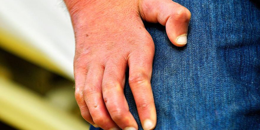 Türkiye'de cüzzam azalıyor