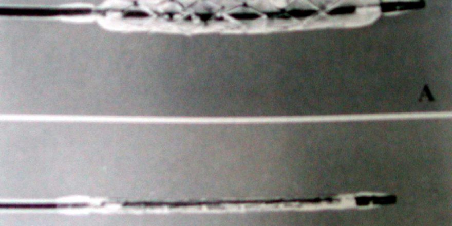 Beyin damarındaki tıkanıklıkta "stent" hayat kurtarmaya vesile oluyor