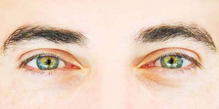 Gözlerdeki bu belirtilere dikkat