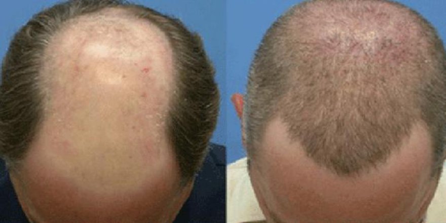 Kelliğe karşı yeni tedavi umudu