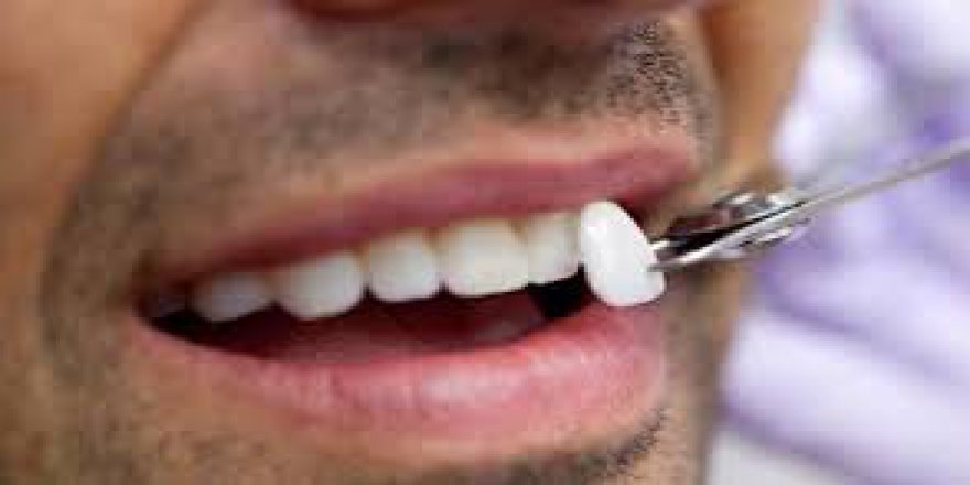 Dişleri beyazlasın diye kaplama yaptırdı, hayatı mahvoldu