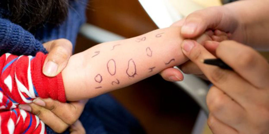 Dünyada gıda alerjileri neden artıyor?