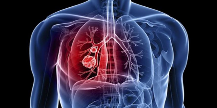 İlginç ölüm: Öksürünce akciğeri fırladı