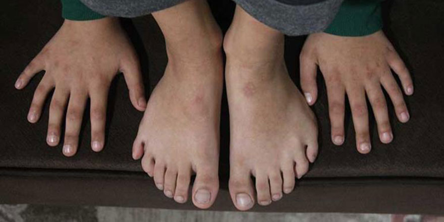 Adanalı Demirhan'ın 24 parmağı var