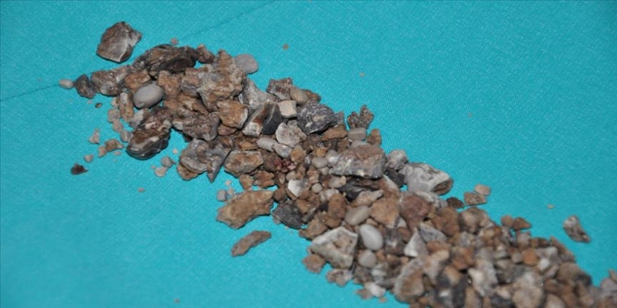 Böbreklerinden 500'den fazla taş çıktı