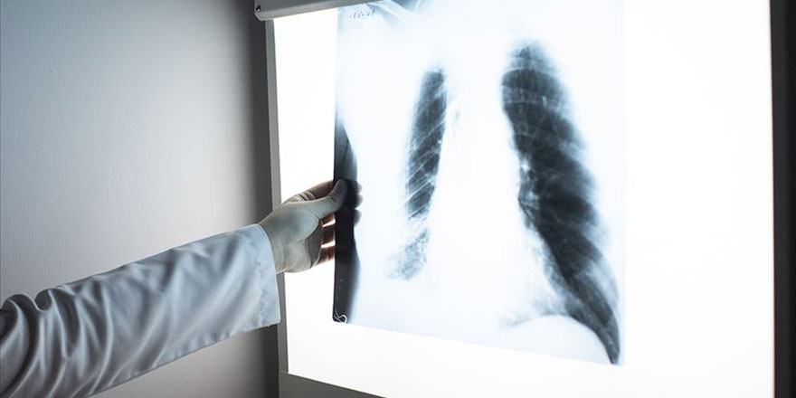 Türk mühendis, röntgen filmlerinden koronayı teşhis eden sistem geliştirdi