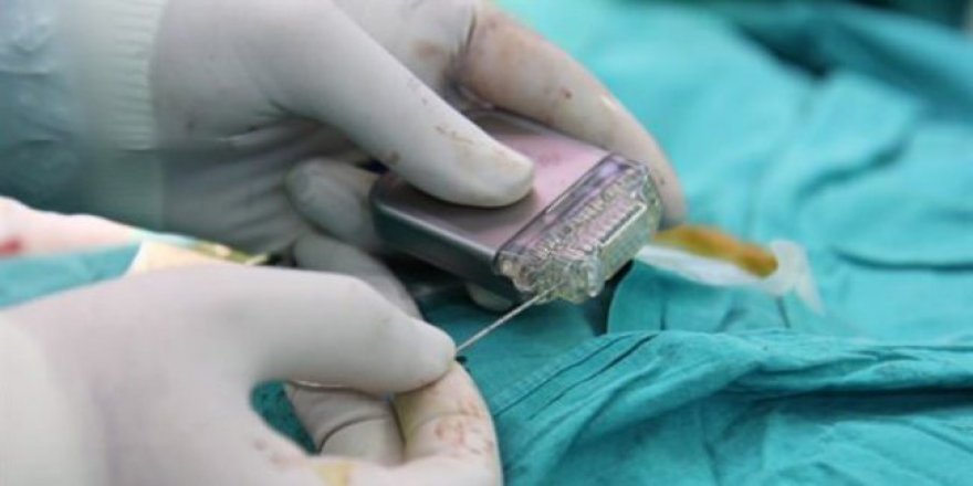 "Beyin pili" uygulaması hastaları yaşama bağlıyor