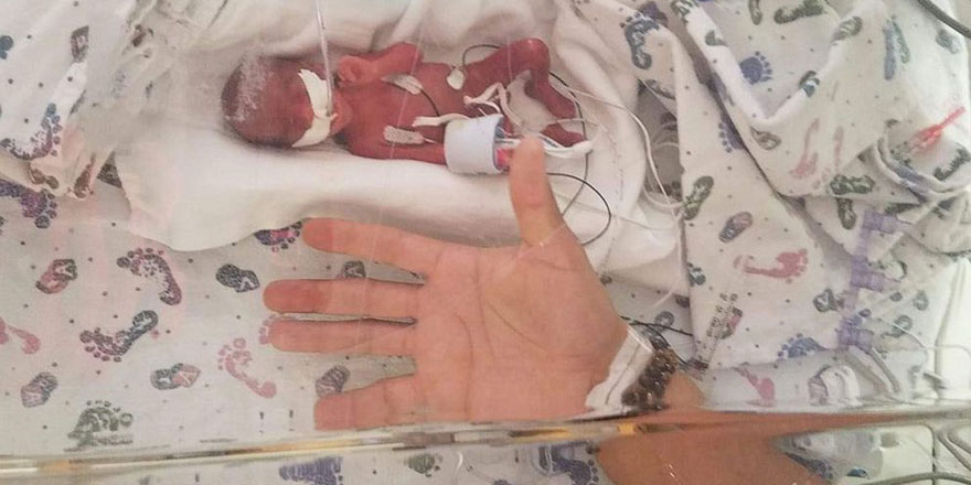 Allah'tan umut kesilmez: ABD’de 368 gram ağırlığında bebek dünyaya geldi