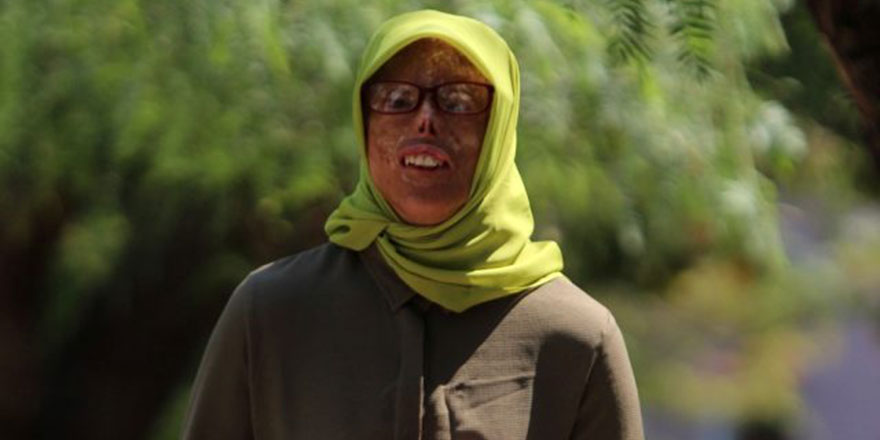 Yüzüm yanık diye herkes benden kaçıyor