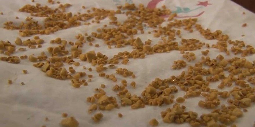 Safra kesesinden bin 50 adet taş çıkarıldı