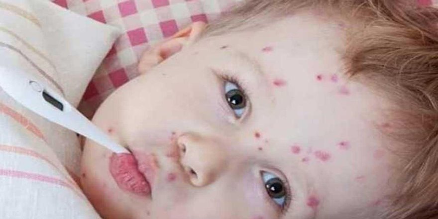 Kızamık geri döndü