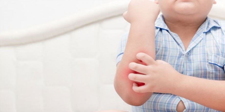 Yaptığı bitkisel karışımla sedef hastalığına çare buldu